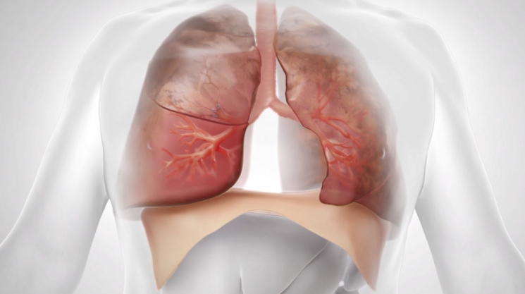 lung-20221231_g10.jpg
