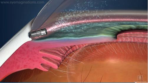 C:\Users\lbreaux\AppData\Local\Microsoft\Windows\INetCache\Content.Outlook\3ZR1CAUR\iDose - right picture (3).tif