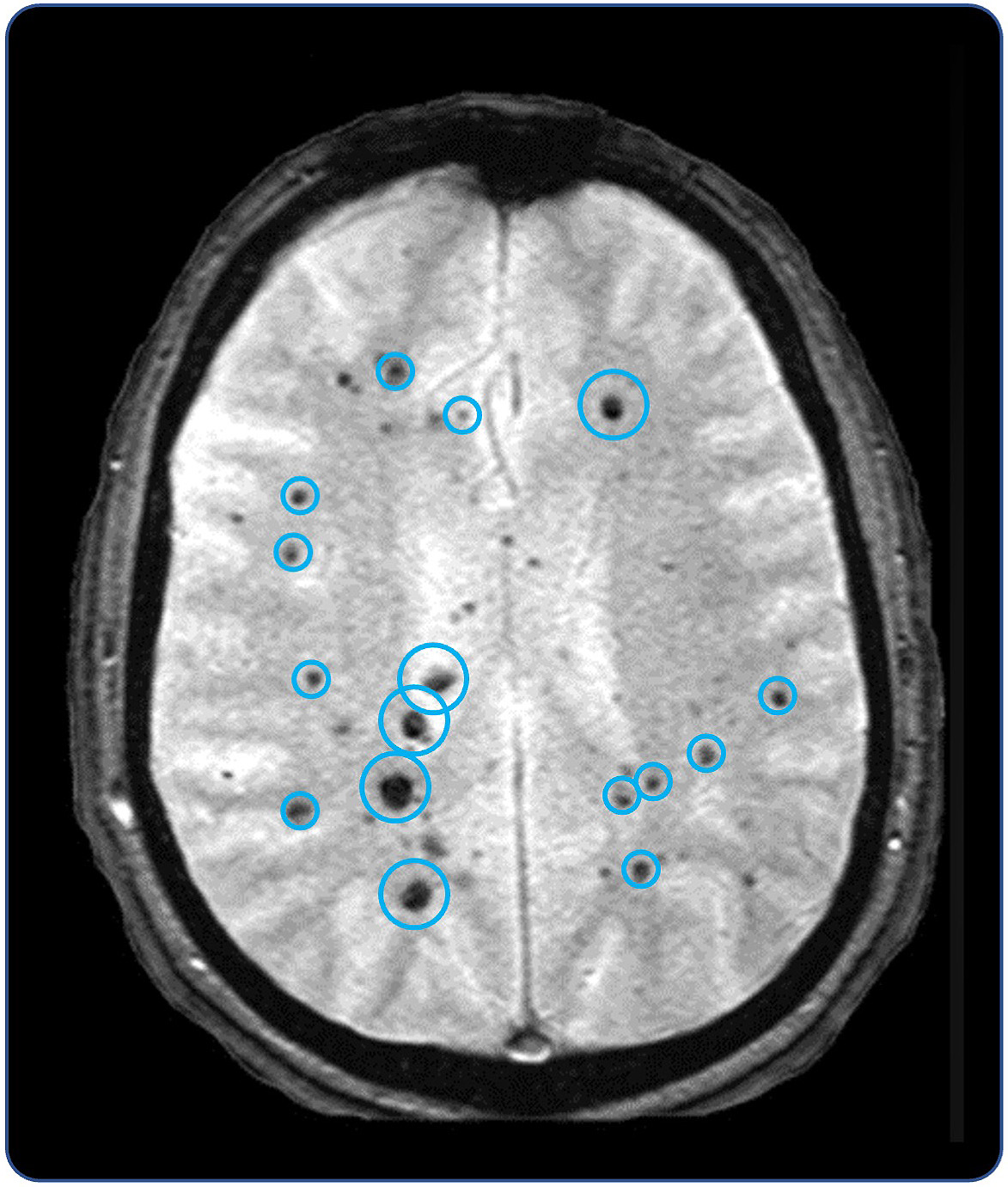 fig 33_vascular cavernomas.jpg